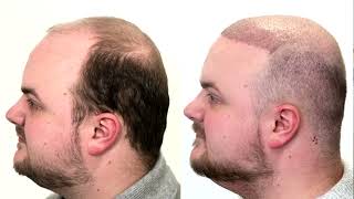 Adams Hair Transplant Experience With Este Medical Group