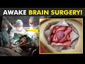 Why Patient Is Awake During This Brain Surgery? (Awake Craniotomy)
