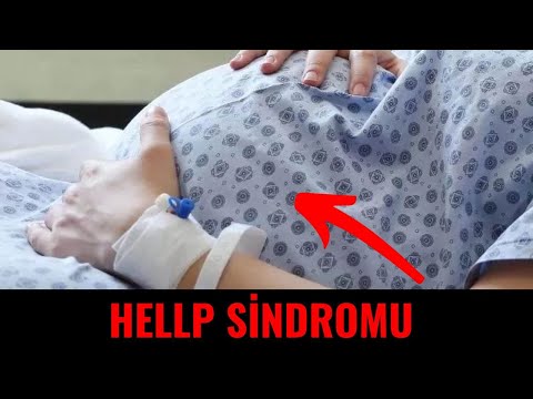 Video: Angelman sindromu - patogenezi, simptomları, diaqnozu, müalicəsi