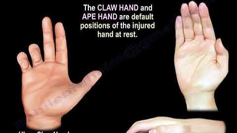Nerve Injury Position of the Hand & Fingers - Everything You Need To Know - Dr. Nabil Ebraheim