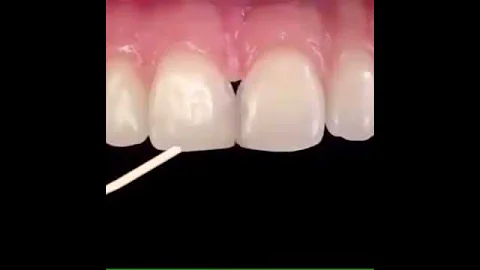 Diastima Closure طريقة اغلاق الفلجة بين الأسنان 