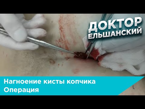 Нагноение кисты копчика операция