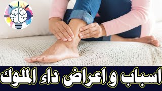 اسباب و اعراض داء الملوك النقرس