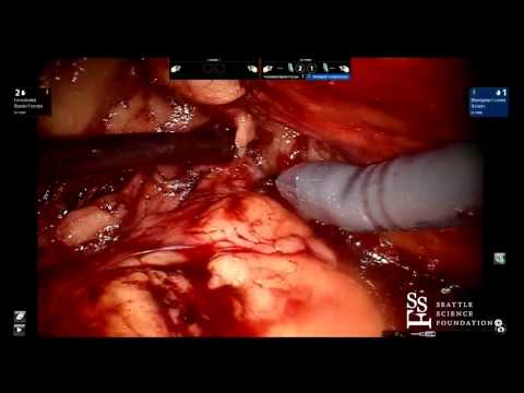 LIVE SURGERY: Retroperitoneal Robotic Partial Nephrectomy