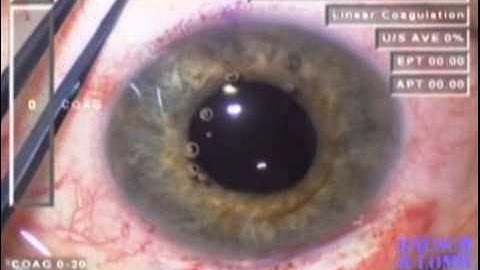 Sulcus Fixation of an IOL Using Scleral Tunnels