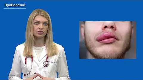 Отёк Квинке
