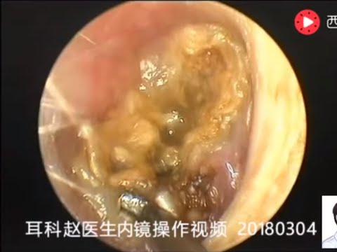 Video: Mga Ear Cst (Cholesteatoma) Sa Mga Aso