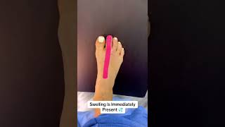 TOE SHORTENING SURGERY OF VERY LONG TOES😎#shorts #toeshorteningsurgery