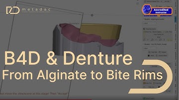 Digital Dentures: From Alginate Impression to 3D Printed Bite Rims
