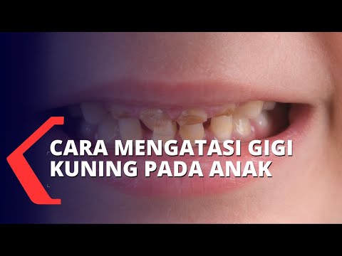 Video: Cara Memutihkan Gigi Pada Anak