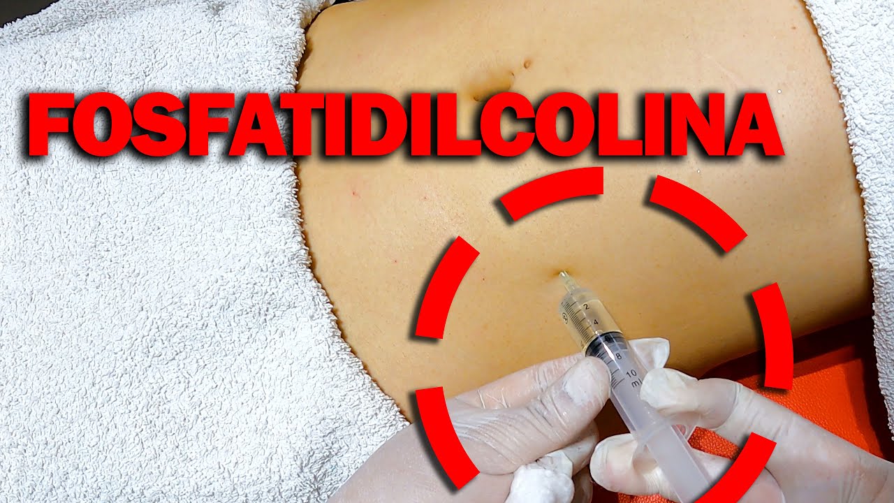 fosfatidilcolina y l carnitina 🔴 FOSFATIDILCOLINA: Como actúa? en ADIPOSIDAD LOCALIZADA CURSO de LIPÓLISIS QUÍMICA🏅 MESOTERAPIA best cream for uneven skin tone Esophagogastric anastomosis in rats: Pack:1 Bottle