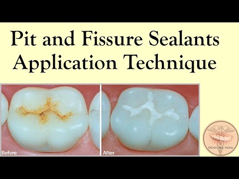 Technique for pit and fissure sealant application - Clinical Skills in Dentistry @DentCareNepal