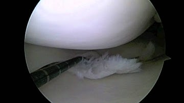 Arthroscopic Partial Medial Meniscectomy