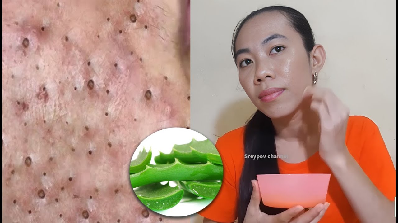 how to Aloe Vera fight acne and scar and acne removal YouTube