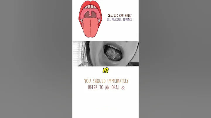 Oral Cancer or Oral squamous cell carcinoma (OSCC)