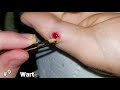 Weird side of youtube  best pimple pops and extractions