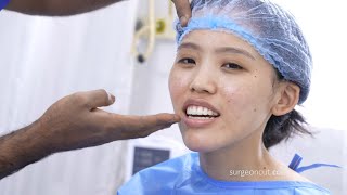 Jaw Plastic Surgery for Gummy Smile | Beautiful Results After Surgery