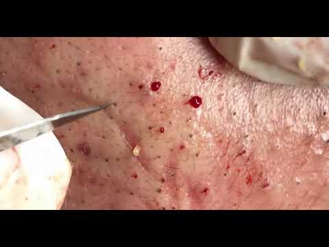 Cleaner Face; Blackheads, Whiteheads, Acne Removal 1; (Full Screen) Super Big Pops