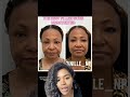 The best filler goes undected 💁🏾♀️ #filler #aesthetics #coameticnurse