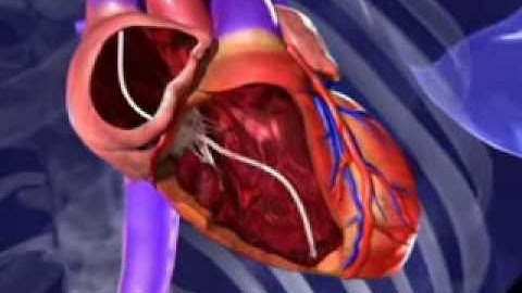 The Defibrillator Device That Can Resynchronize Your Heart