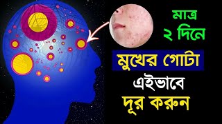 বাজে কাজে আসা মুখের ব্রণ দূর করার টিপস | How to Remove Your Facial Pimples Without Investing Money screenshot 1