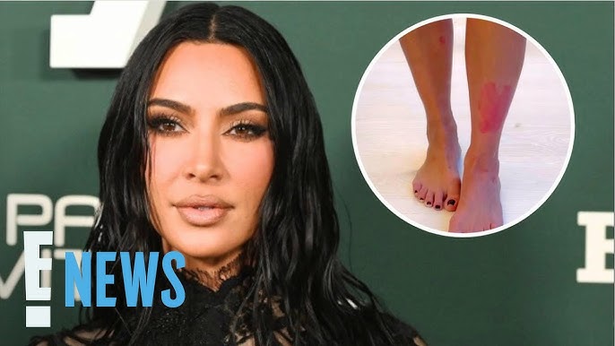 See Kim Kardashian S Painful Psoriasis Flare Up On Her Leg E News