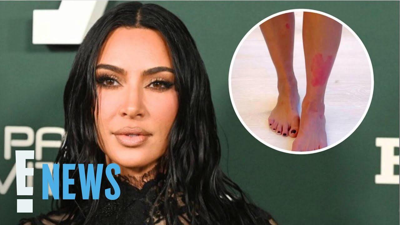 Kim Kardashian Psoriasis Video Shows 'Painful' Flare-Up And Her ...