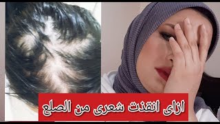 ازاى انقذت شعرى من الصلع