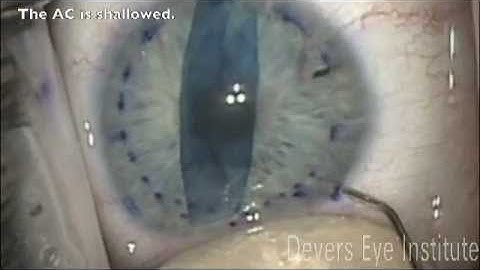 DMEK Corneal transplant using a no-touch "tap-technique"