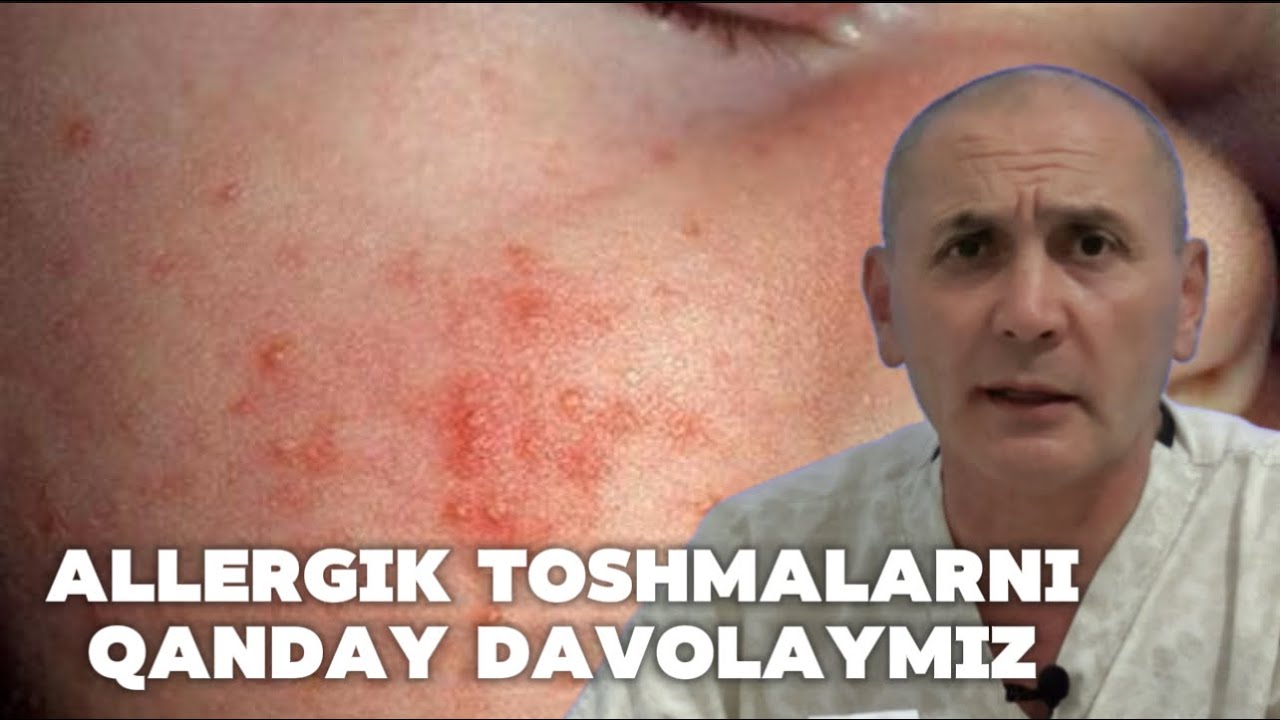 Аллергия ва тошмаларни парҳезсиз қандай йўқ қилдик?