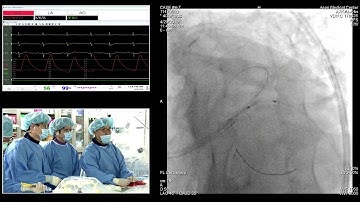 [TCTAP 2019] Coronary Symposium - Live Case Session IV