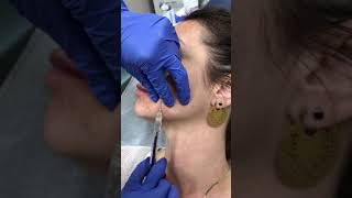 Filling facial lines with a Restylane Defyne