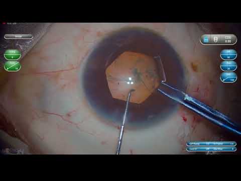 Shallow AC Bhex small pupil Dr Sourabh Patwardhan Live #Cataract surgery. call 7028402375