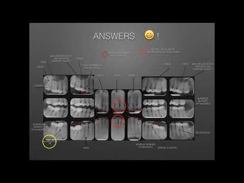 Video: När ska röntgenbilder monteras?