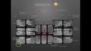 The Full Mouth Xray Survey Identification & Film Mounting
