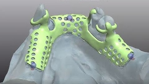 3Shape CAD training Mesh RPD-#5