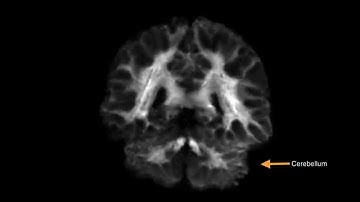 Whole brain diffusion MRI fiber tracking