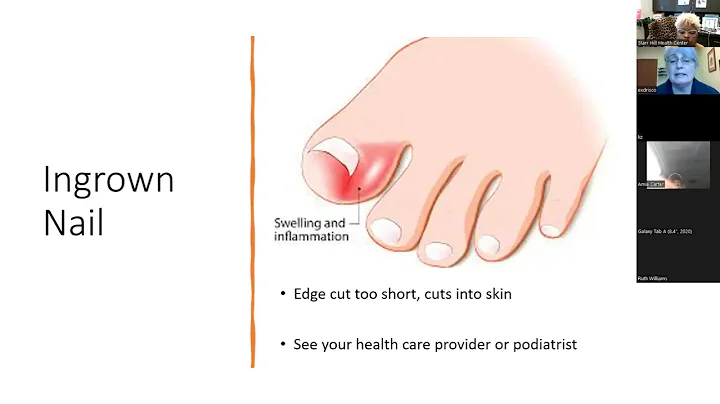 Diabetes Foot Care (April 2022) - Elizabeth Drisco...