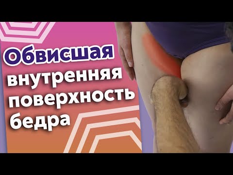 Что делать, если внутренняя поверхность бедра обвисла? / Как убрать целлюлит на бёдрах?