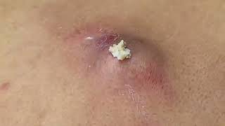 رؤوس سوداء وبيضاء Alovely day with juanna  (super Big pimples )