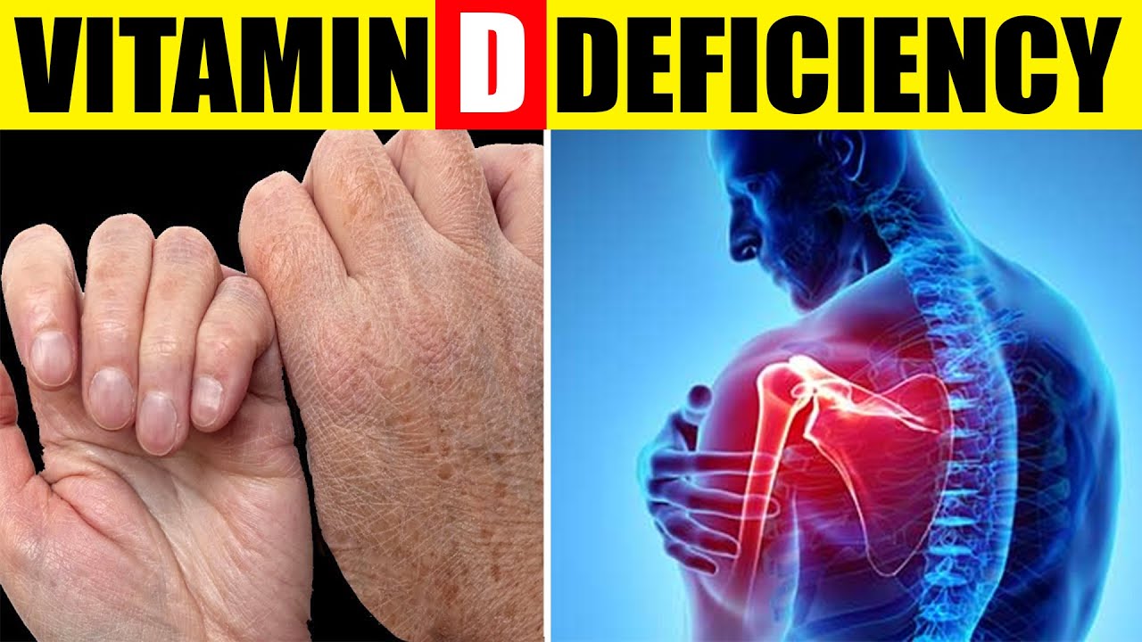 10 Signs Your Body Is Begging for Vitamin D