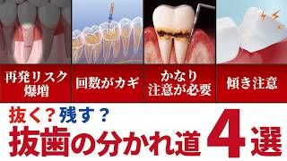 究極の選択!歯医者によって抜くか残すか分かれる歯4選