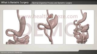[시연용] c0199aaen What is Bariatric Surgery