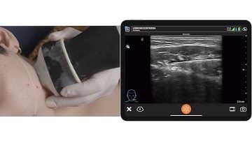 Botulinim Toxin Injection into Masseter