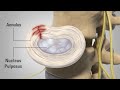 Patient Animation - Lumbar Degenerative Disc Disease