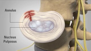 Patient Animation  Lumbar Degenerative Disc Disease