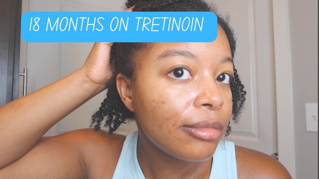 18 MONTH Update on TRETINOIN, Clindamycin/Benzoyl Peroxide, & Topicals