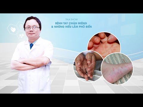 Bác sĩ Trương Hữu Khanh giải đáp: Bệnh tay chân miệng ở trẻ và những sai lầm của cha mẹ Bác sĩ Trương Hữu Khanh giải đáp: Bệnh tay chân miệng ở trẻ và những sai lầm của cha mẹ