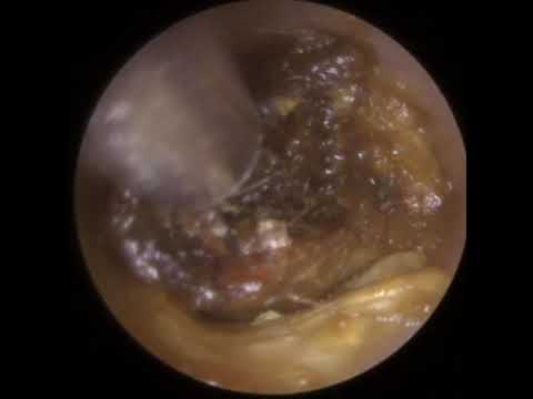 832 - Very Impacted Ear Wax Removals