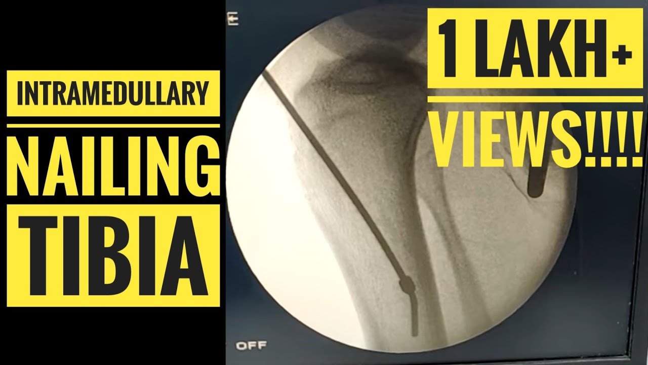Broken Leg: If my tibial shaft fracture gets surgery, when can I start  walking on it? — Bone Talks